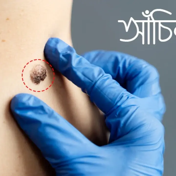আঁচিল কী? কারণ, লক্ষণ ও নিরাপদ চিকিৎসা পদ্ধতি
