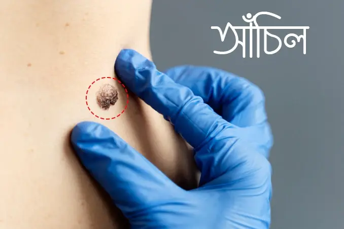আঁচিল কী? কারণ, লক্ষণ ও নিরাপদ চিকিৎসা পদ্ধতি